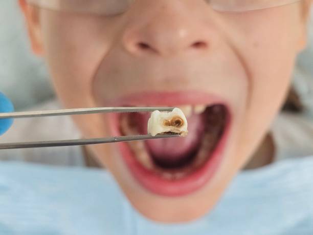Best Emergency Tooth Extraction in Cocoa, FL